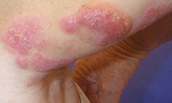 Kutanöz Lenfoid Hiperplazi Nedir?