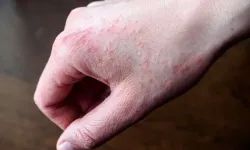 Uzmandan Uyarı: Bebeklerde Egzamada Gereksiz Diyet Alerji Riskini Artırabilir