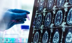 Alzheimer Yıllar Öncesinden Başlıyor: Yeni Araştırma Erken Döneme Işık Tuttu