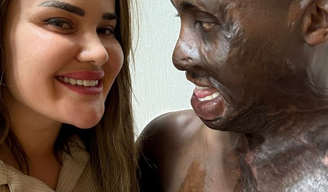 Ugandalı çoban Ankara'da tedavi edildi