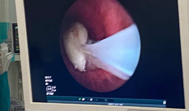 Akciğerine kaçan sarımsak operasyonla çıkarıldı