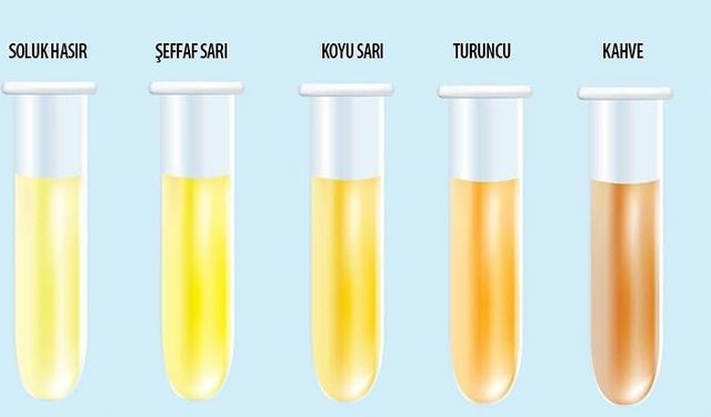 Berrak mı, Koyu mu? İdrar Rengi Sağlığın Şifresini Taşıyor!