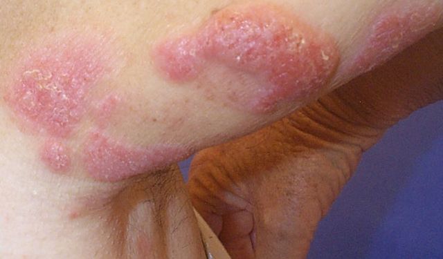 Kutanöz Lenfoid Hiperplazi Nedir?