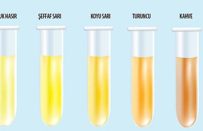 Berrak mı, Koyu mu? İdrar Rengi Sağlığın Şifresini Taşıyor!