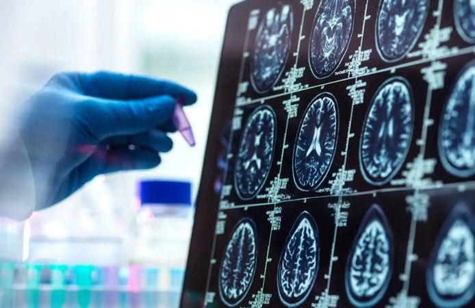 Alzheimer Yıllar Öncesinden Başlıyor: Yeni Araştırma Erken Döneme Işık Tuttu