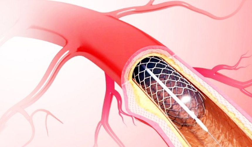 Kalp Tedavisinde Kafa Karışıklığı: Stent mi, Ameliyat mı?
