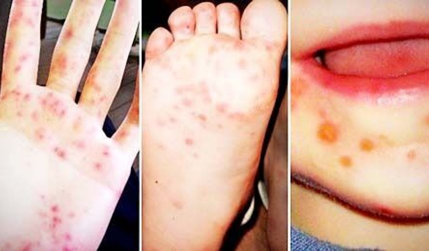 Uzmanlardan Kırmızı Alarm: “El-Ayak-Ağız Hastalığı Kapıda”