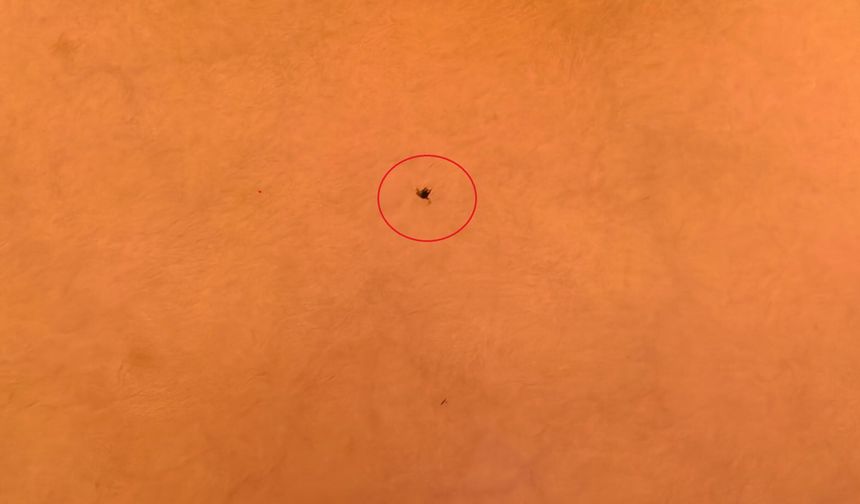 İnegöl’de Çocuğun Göğsüne Yapışan Kene Hastanede Çıkarıldı