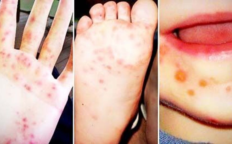 Uzmanlardan Kırmızı Alarm: “El-Ayak-Ağız Hastalığı Kapıda”