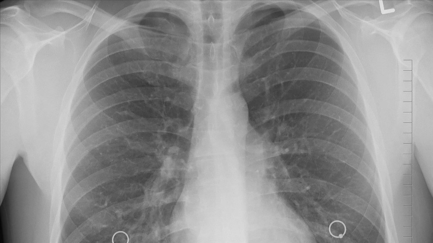 Akciğer Kanseri Tanısında Devrim2